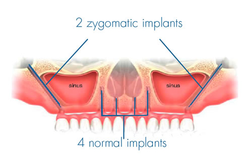 הכל אודות שתלים זיגומטיים – ZYGOMA INPLANTS  