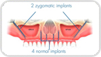 הכל אודות שתלים זיגומטיים – ZYGOMA INPLANTS aruts 2 reflex