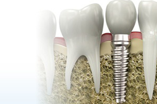 Teeth - The Implants That Are Taking Root